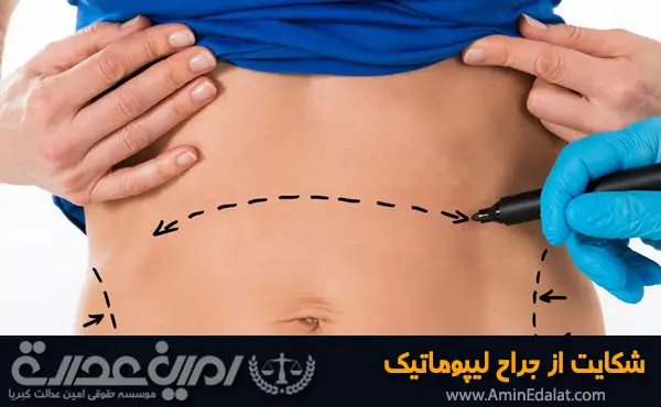 شکایت از جراح لیپوماتیک