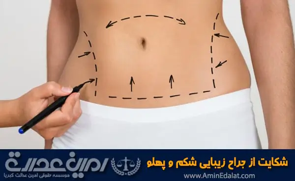 شکایت از جراح زیبایی شکم پهلو