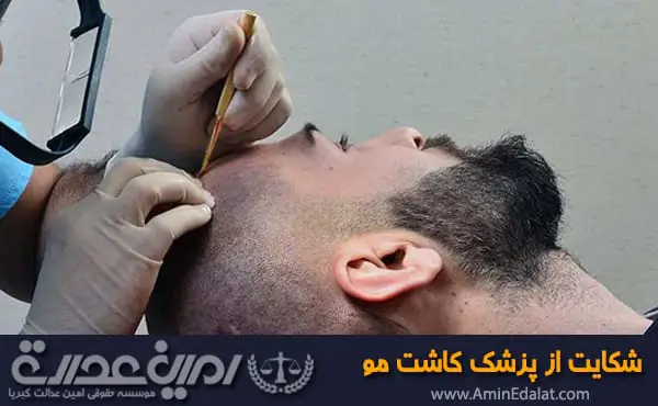 شکایت از پزشک کاشت مو